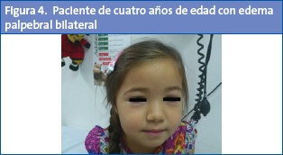 Paciente de cuatro años de edad con edema palpebral bilateral